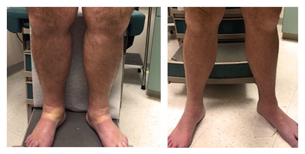 DVT Treatment Before and After